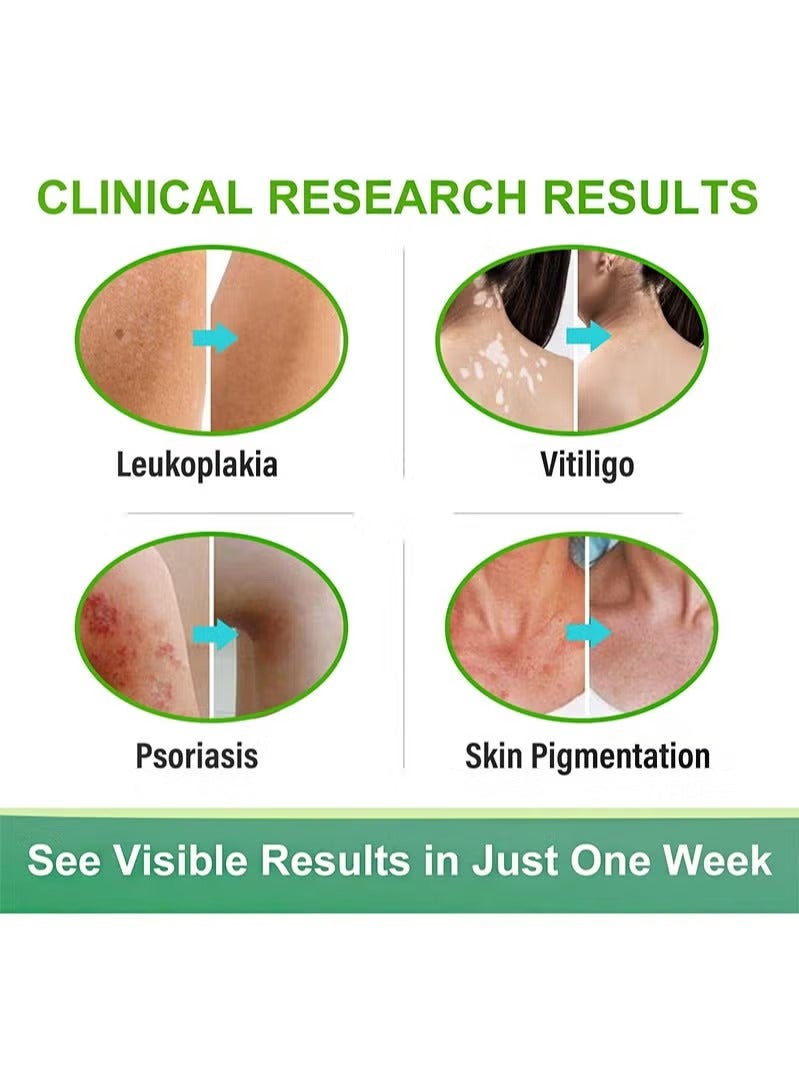 Sumifun Vitiligo Ointment, Skin Vitiligo Treatment, Vitiligo Care Cream Reduces White Spots and Improves Skin Pigmentation (20g) - Image 4