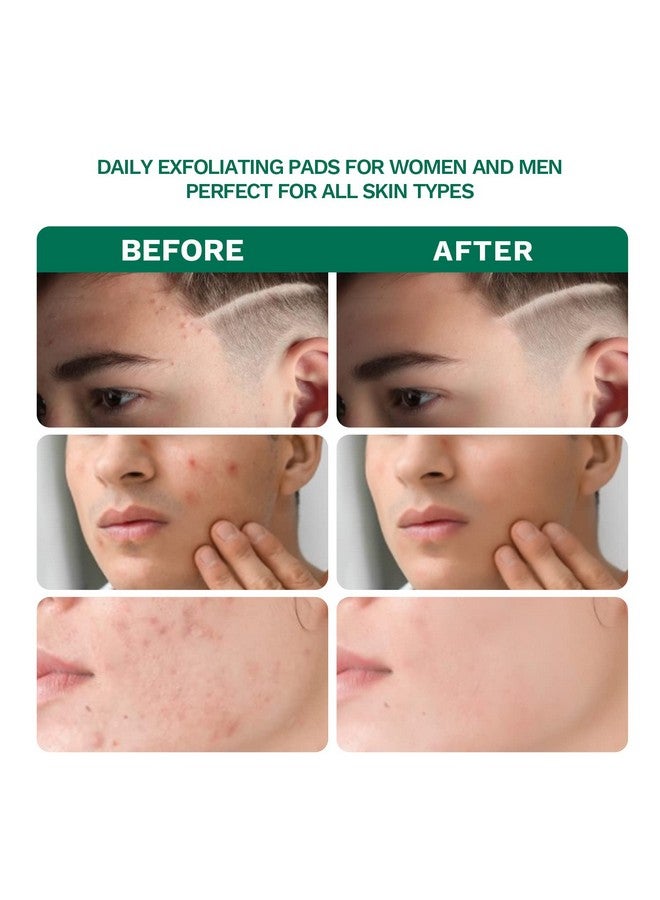 ANAI RUI 2% Salicylic Acid Acne Padsacne Treatment Pads Face Cleansing Pads Witch Hazel Pads For Acne & Blemishes Clear Facial Peel Resurfacing & Exfoliating Face Wash Wipes 80 Count - Image 4