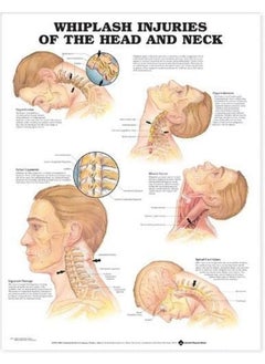 Whiplash Injuries of the Head and Neck Anatomical Chart 