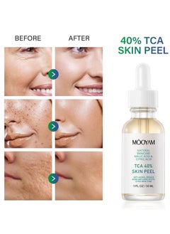 MOOYAM 40% Citric Acid Peeling Serum Chemical Peel for Face Peeling Solution Skin Peel Chemical Exfoliant for Face Exfoliating Facial Peel for Dark Skin Dark Spots Acne Spot 30ml  - Image 3