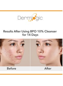 Dermlogic Acne Treatment- 5% Benzoyl Peroxide Face & Body Wash- Penetrates Deep within Pores to Immediately Fight Zits to Clear Skin. Eliminates and Prevents New Pimples from Forming.  - Image 2