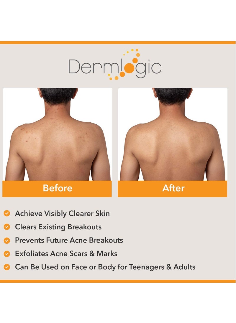 Dermlogic Acne Treatment- 5% Benzoyl Peroxide Face & Body Wash- Penetrates Deep within Pores to Immediately Fight Zits to Clear Skin. Eliminates and Prevents New Pimples from Forming.  - Image 3