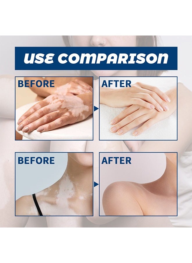 SOL LORA - Vitiligo Ointment, Vitiligo Care Cream for Skin Vitiligo, Psoriasis, Leukoplakia, Reduces White Spots, Improve Skin Pigmentation Regulating  20g - Image 1