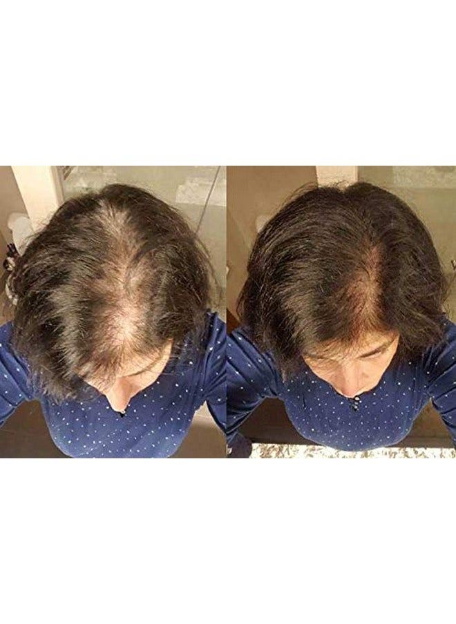 زيناجين علاج تساقط الشعر الكثيف للنساء 6.75 أونصة سائلة. أوز.  - Image 2
