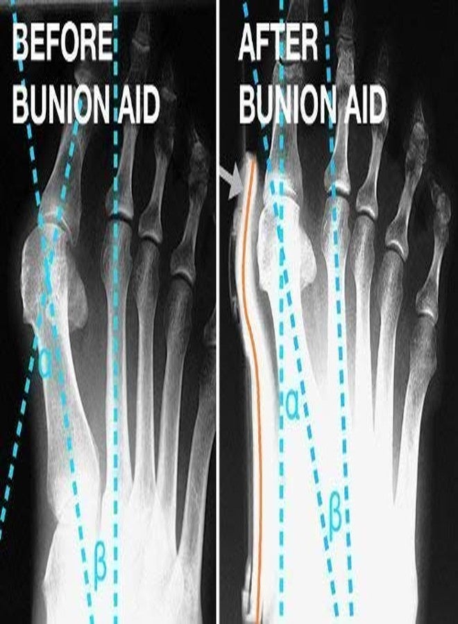 GION Silicone Gel Foot Fingers Bunion Corrector and Bunion Relief Sleeve with Gel Bunion Pads Cushion Splint Bunion Protector for Men and Women // Hallux Valgus Corrector Bunion Bootie Guard (1Pair) - Image 3