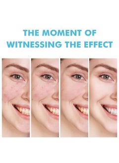 MOOYAM Salicylic Acid Acne Gel 12H Results Soothing Acti Redness Acne Cream Repair Damaged Skin Oil Control Tighten Pores Moisturizing Hydrating Acne Treatment Cream 20g  - Image 5