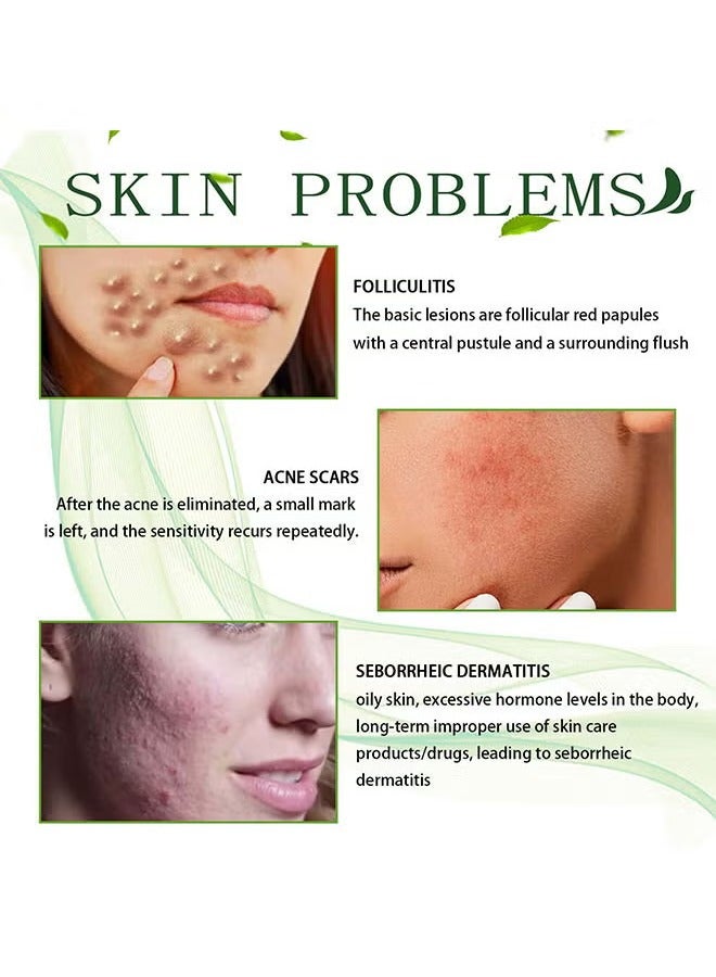 SOUTH MOON Acne Treatment Face Cream Acne Spot Treatment For Face And Acne Dots Natural Cystic Acne Treatment For All Skin Types Premium Acne Scar Cream And Pimple Remover 30ML  - Image 3