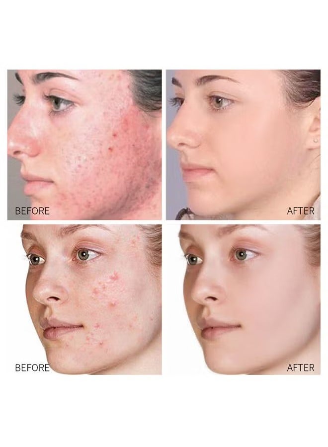 SOUTH MOON Acne Treatment Face Cream Acne Spot Treatment For Face And Acne Dots Natural Cystic Acne Treatment For All Skin Types Premium Acne Scar Cream And Pimple Remover 30ML  - Image 5