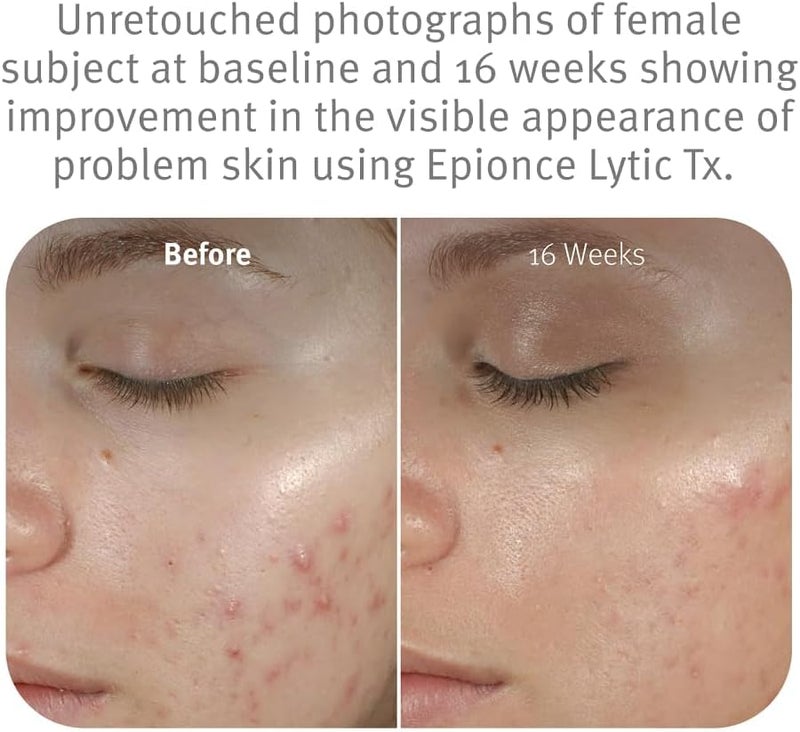 Epionce Lytic Plus Tx Retexturizing Lotion for Combination to Oily Skin - 50ml - Image 3