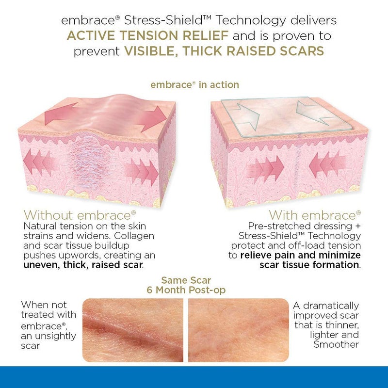 Embrace Active Scar Defense for New Scars, FDA-Cleared Medical-Grade Silicone Scar Sheets for Hypertrophic & Keloid Scar Treatment, 4.7 Inch, Large, 30-Day Supply - Image 2