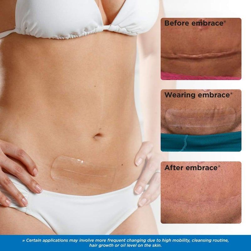 Embrace Active Scar Defense for New Scars, FDA-Cleared Medical-Grade Silicone Scar Sheets for Hypertrophic & Keloid Scar Treatment, 4.7 Inch, Large, 30-Day Supply - Image 5