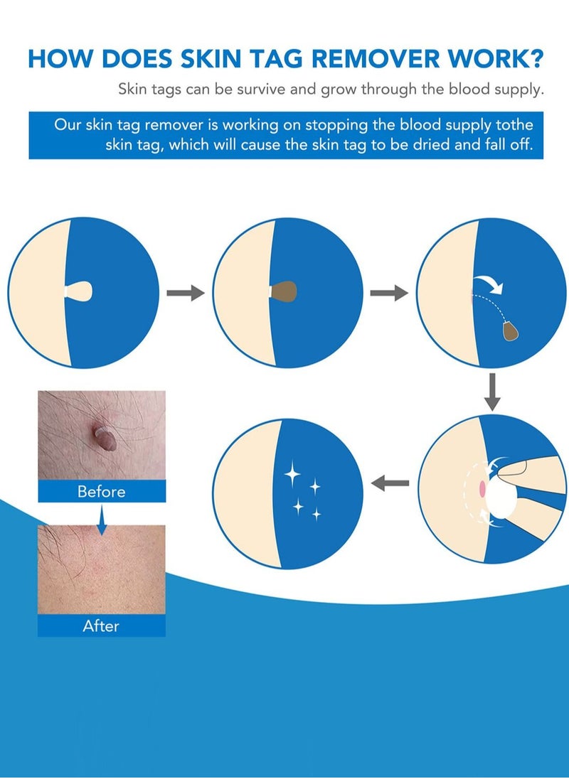 2 in 1 Wart Removal Tool Skin Tag Removal Double Head Kit Painless Easy-Using Device for Small to Large Sized Skin Tag on Face Neck and Body Blue