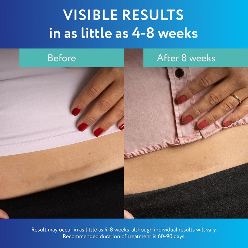 ScarAway Advanced Clear Silicone Scar Sheets, Medical Grade Silicone Strips (1.5" x 3") Scar Treatment and Prevention for Surgical, Burn, Body, Hypertrophic & Keloid Scar Treatment, 6 Clear Sheets - Image 4