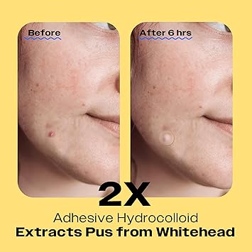Avarelle Pimple Patches 24 AM Daytime Vegan and Cruelty Free Ultra Thin Hydrocolloid Cover Patches - Image 3