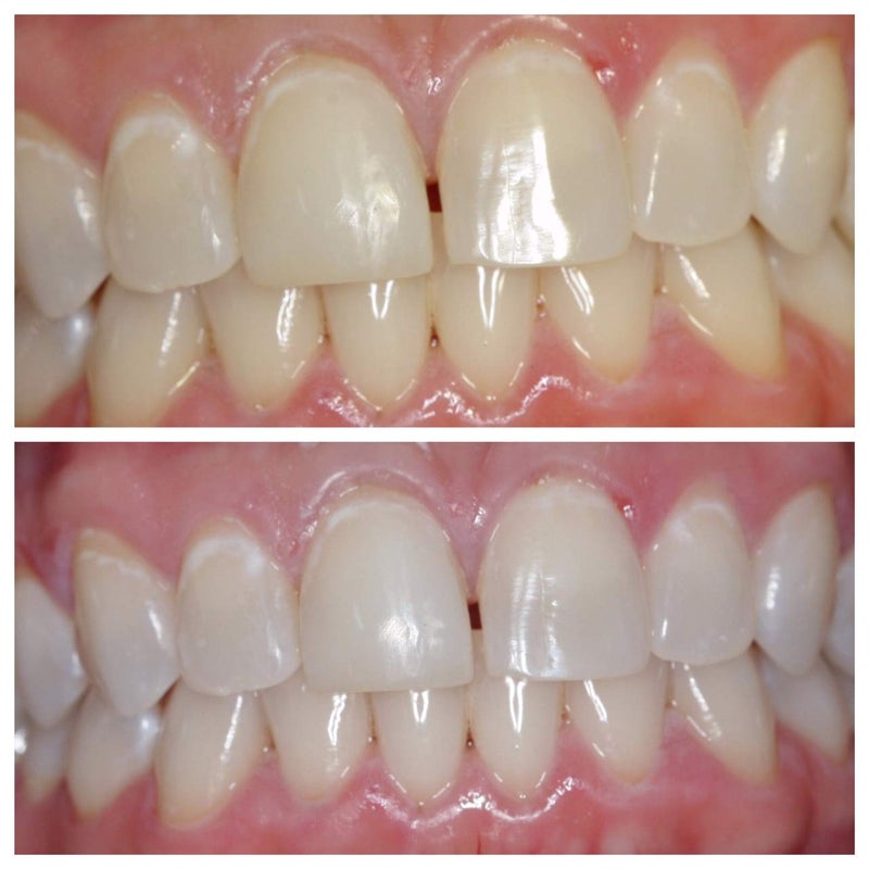 Ultra White جل تبييض الأسنان الأبيض الفائق 22% - 5 أنابيب كبيرة 3.8 مل من الجل للحصول على ابتسامة بيضاء جميلة - Image 4