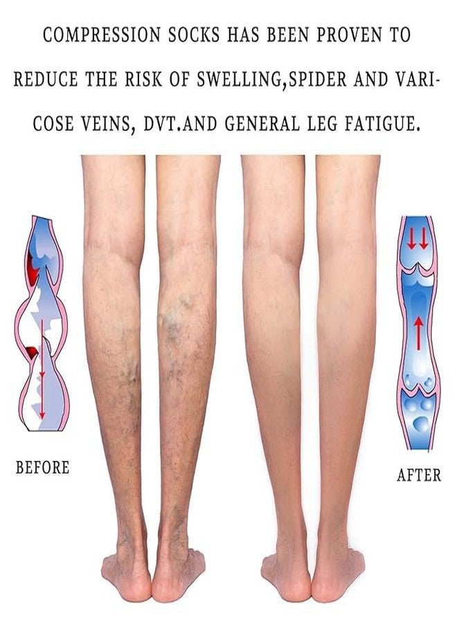 Dr Helix Varico Vein Compression Stocking Thigh High(XL) - Open Toe Support Socks for Men & Women - Skin & Black Color Combo - Improves Circulation, Reduces Swelling & Leg Fatigue - (Pack of 2) - Image 4