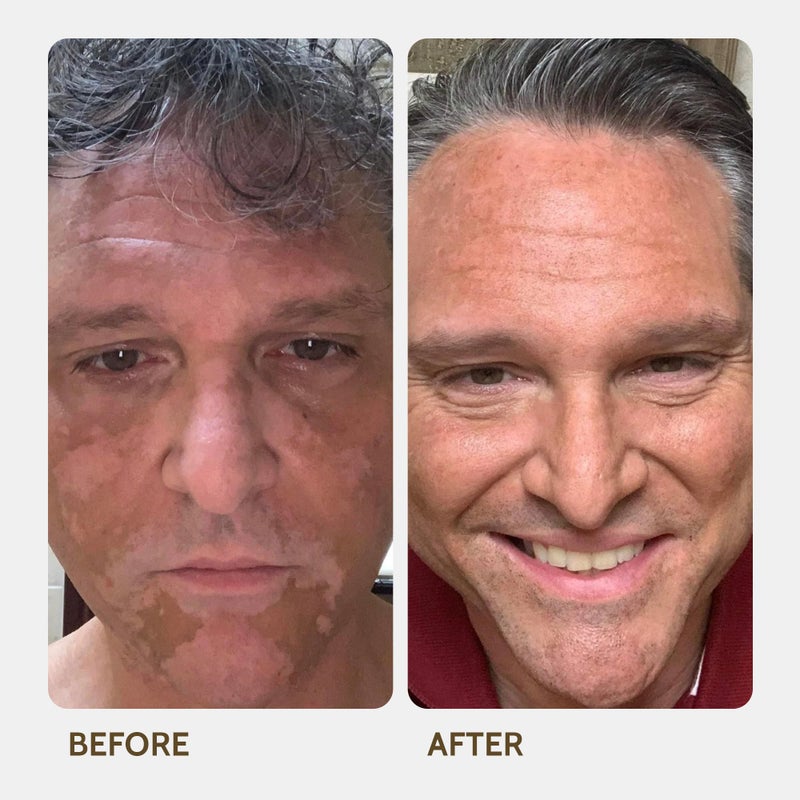 Fake Bake Vitiligo Vanquish Cosmetic Camouflage Kit by Fake Bake Liquid Concealer, Long Lasting Natural Color Customization Eliminates Appearance of Skin Depigmentation For Women & Men - Cover Lasts For Days - Image 5