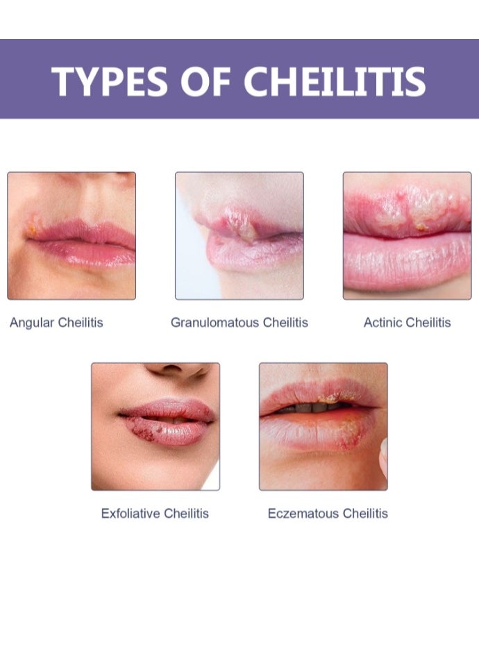 EELHOE Lips Care Pimple Patches,Lips Acne Hydrocolloid Patches,Lips Care Spot Patches,Lips Clear Patches,Invisible Lip Acne Healing Patch Repair Lip Condition,36Pcs  - Image 3