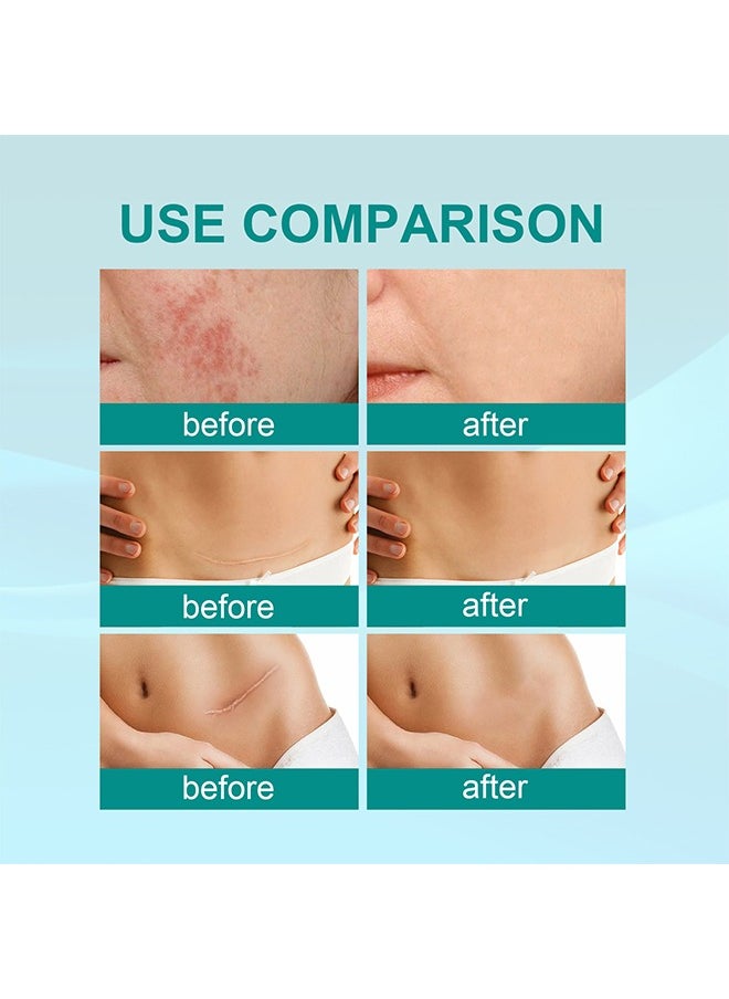 SOUTH MOON - Medical Grade Scar Spray for Reduce Scars and Smooth Skin, Smoothing Skin Care Mist Moisturizes The Skin, Smooth And Translucent Mist 20g - Image 1