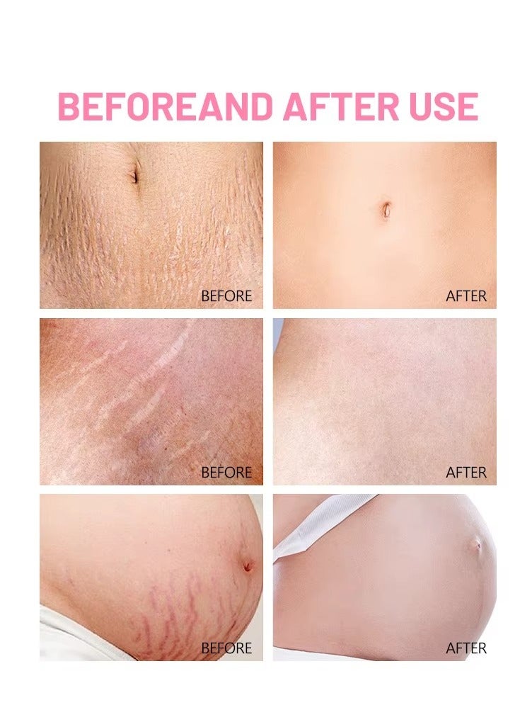 Aichun beauty Anti Stretch Mark Body Oil 120ml Natural Skin Firming and Hydrating Oil for Scars and Stretch Marks - Image 4