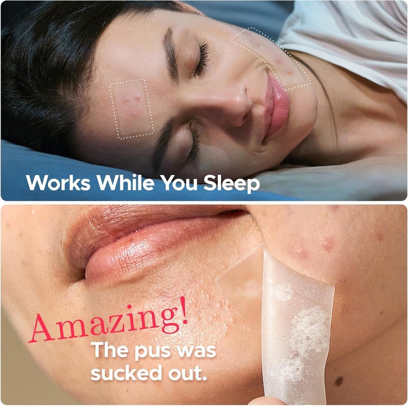 LitBear Large Pimple Patches, 5 Sizes 156 Patches Big Acne Patch, 60 XL Hydrocolloid Patch for Full Face, Forehead, Chin, Nose, Body, Back, Neck & Chest, Stirp, Square Large Hydrocolloid Bandages - Image 5