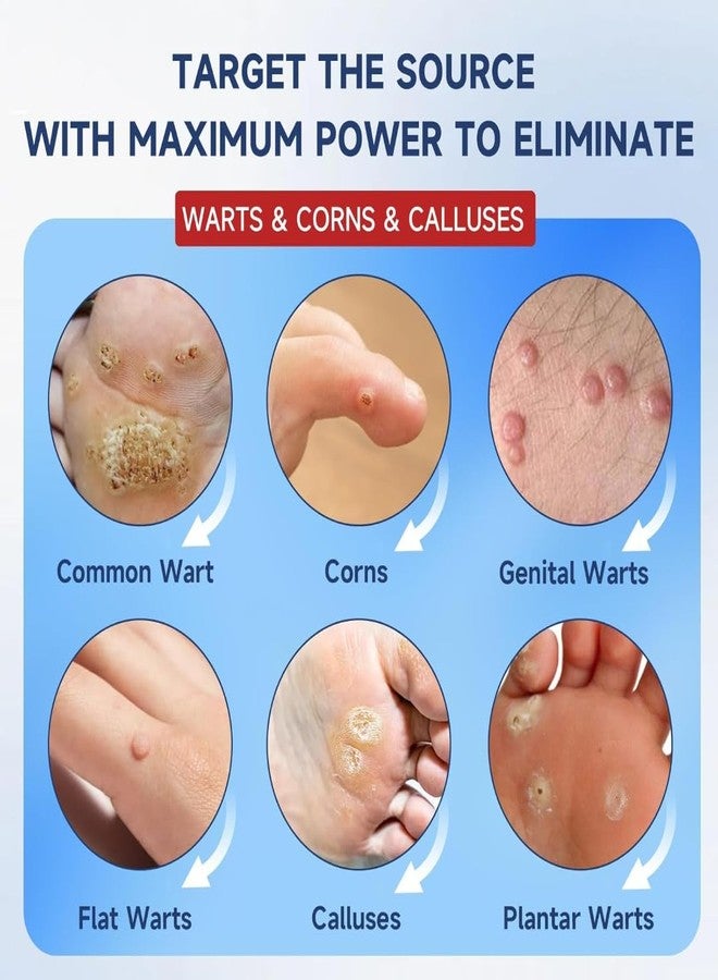 SYLVERA Fast-Acting Wart Remover with Salicylic Acid | Skin Tag Removal Solution for Women & Men | Effective Treatment for Common, Plantar & Genital Warts | Wart & Skin Tag Removal Liquid (Pack of 1) - Image 2
