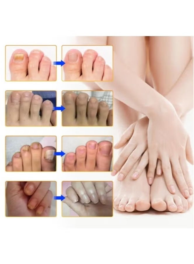 Sefudun Toenail Fungus Treatment Extra Strength - 32 Pcs Fungal Nail Patches, Nail Repair for Damaged Nails, Overnight Renewal for Men and Women - Image 4