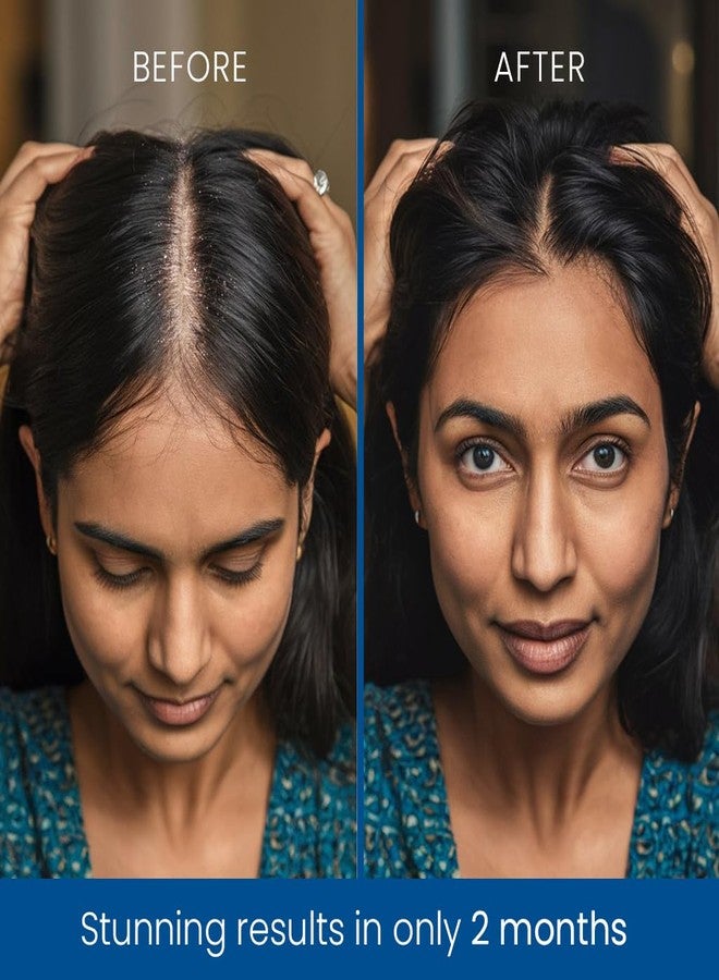 إلفن شامبو إلفن المضاد للقشرة - 250 مل | تركيبة فعالة لشعر وفروة رأس خاليين من القشرة | مكونات مغذية وملطفة - Image 5