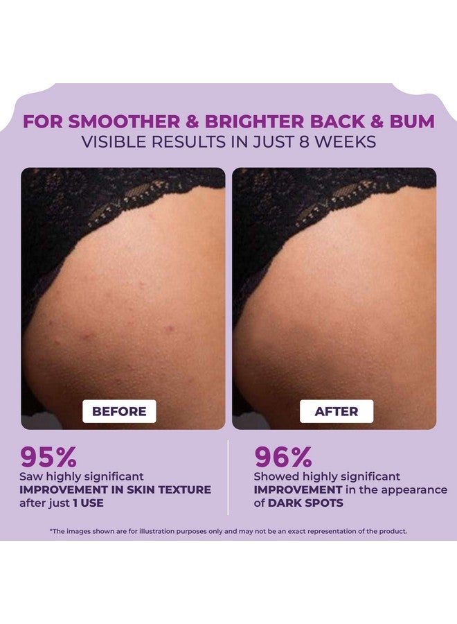 Sanfe كريم سانفي للظهر والمؤخرة للبقع الداكنة وحب الشباب | حمض الجليكوليك، حمض اللاكتيك ويوريا | 11% AHA وأقصى تقشير | إزالة الجلد الميت للنساء | 100 جرام - Image 2