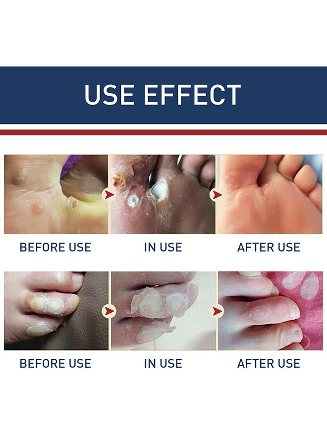 SOUTH MOON - 24 Pcs Foot Corn Removal Plaster,Natural Ingredients,Foot Care Expert,Calluses Plantar Treatment,Relief Pain From Calluses, Corns, Blisters, Heel Frictions - Image 1