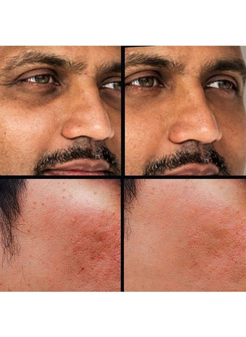 كونسيلر (درجة 2 من 6) كريم تصحيح الهالات السوداء تحت العين، متعدد الاستخدامات، البثور، الندبات، الطفح الجلدي