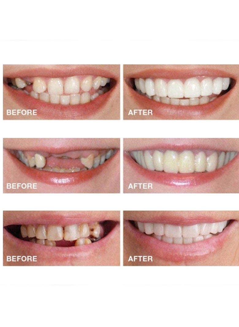 SNAP - Teeth Veneers Anti-true Braces Snap On Smile Teeth Whitening Denture Teeth Comfortable Veneer Cover Teeth - Image 1