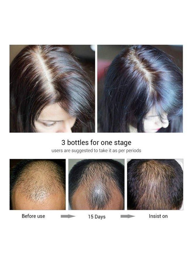 Hair Growth Essence Spray Anti Hair Loss Hair Serum Ginger Hair Growth Serum Spray Natural Hair Growth Accelerator For Stronger Thicker Longer Hair Hair Serum For Hair Growth And Thickening