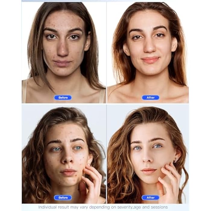 NEWKEY LED Face Mask Light Therapy,Red Light Therapy for Face Wrinkle Blue Light Therapy Mask for Face Acne,150LEDs,10 Min Auto Shut off, Wired - Image 4