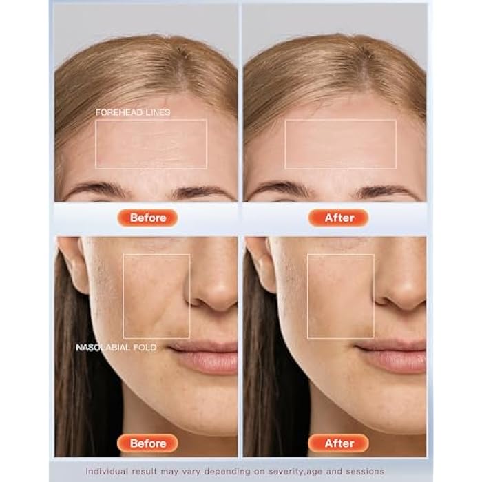 NEWKEY LED Face Mask Light Therapy,Red Light Therapy for Face Wrinkle Blue Light Therapy Mask for Face Acne,150LEDs,10 Min Auto Shut off, Wired - Image 3