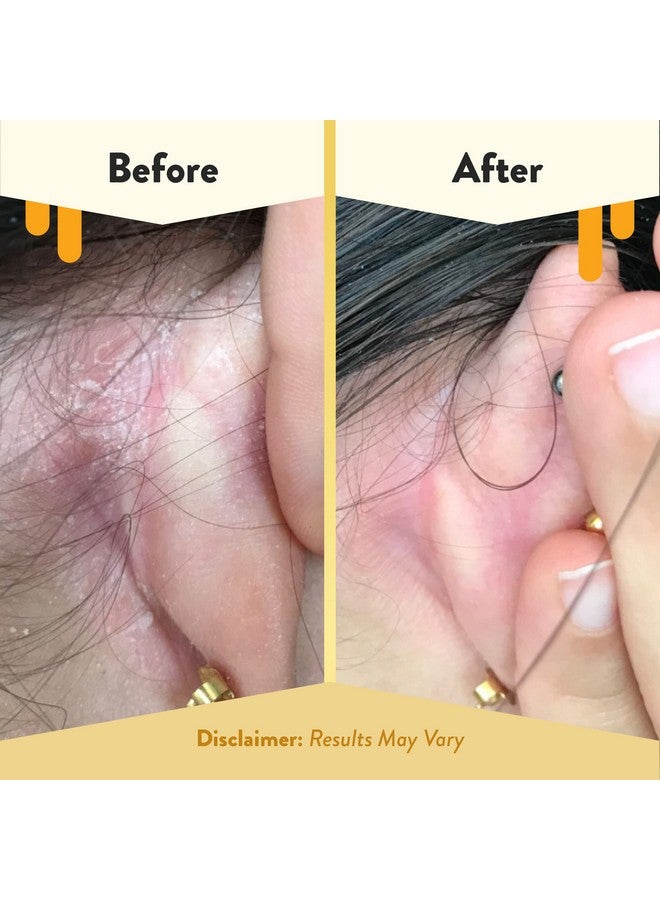 ECZEMA HONEY Gentle Face & Body Lotion Stick - Moisturizing Colloidal Oatmeal Hand Cream for Extremely Dry Skin - Eczema Lotion Helps Psoriasis, Dermatitis & More (2.2 Oz) - Image 4