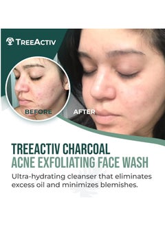 TreeActiv TreeActiv Acne Charcoal Face Wash 3.4 oz, Exfoliating Daily Honey & Sulfur Face Wash - Sulfur Acne Treatment Cleanser Face Soap, Mens Face Wash, Deep Cleansing Moisturizing Face Wash for Women and Men  - Image 3