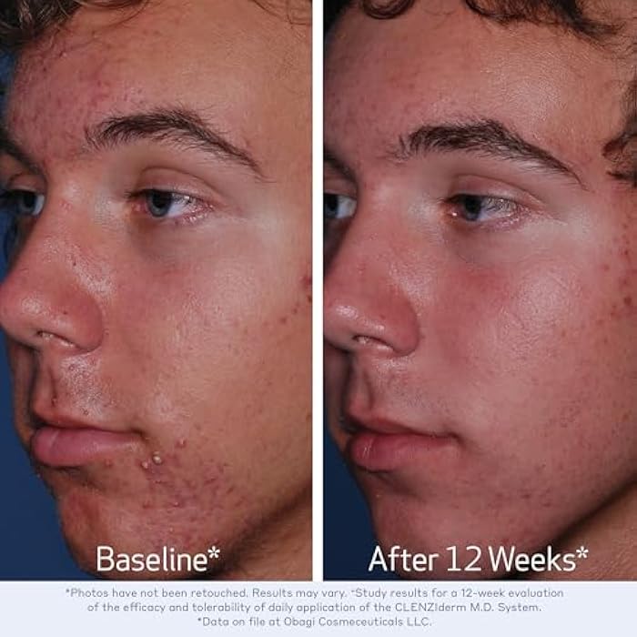 Obagi Medical Obagi CLENZIderm M.D. Daily Care Foaming Acne Cleanser – Acne Treatment with 2% Salicylic Acid (BHA) - Image 4