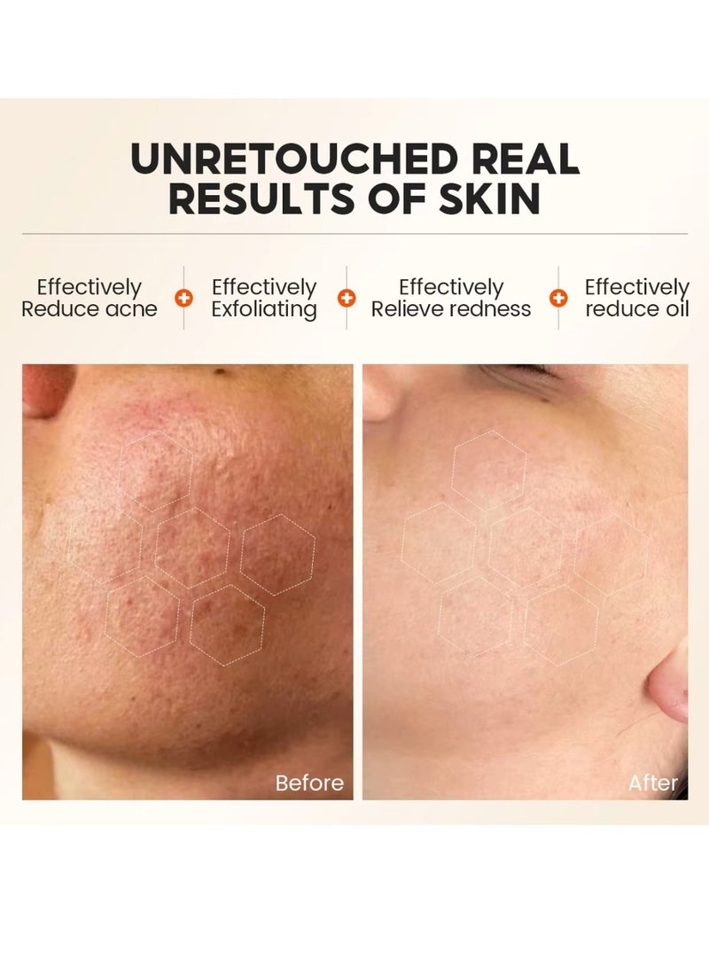 Vibrant Glamour 100g Salicylic Acid Exfoliating Gel Cleanser Deep Pore Cleaning Daily Acne Treatment for Oily Acne Prone Skin Gentle Hydrating Moisturizing Face Exfoliating Gel Cleanser  - Image 2