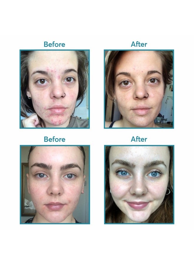 MDacne مكملات تنظيف البشرة من ديم، 30 كبسولة نباتية لعلاج حب الشباب وتوازن هرمون الاستروجين وتخفيف أعراض انقطاع الطمث وبناء العضلات، مستخلص نبات الصليب والبيوبيرين، تركيبة من قبل أطباء الجلدية - Image 3