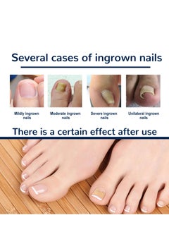 EELHOE Toenail Correction Patch 50 Pieces  - Image 2