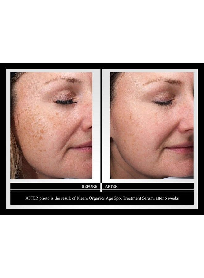 Kleem Organics Best Dark Spot Corrector Serum For Face Hands & Neck This Age Spot Remover Is Formulated With Bio Ingredient For Dark Spots Age Spots & Sun Spots Kleem Organics Dark Spot Remover Is Made In Usa - Image 3