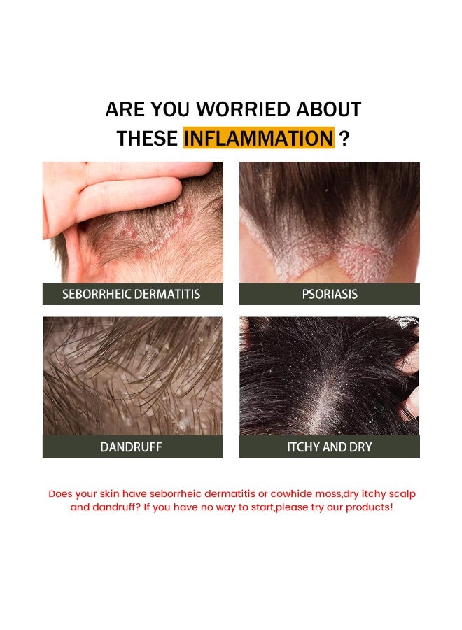 سوميفون كريم التهاب الجلد الدهني، لعلاج التهاب بصيلات الشعر والتهاب الجلد الدهني - يخفف الحكة وجفاف فروة الرأس - Image 3