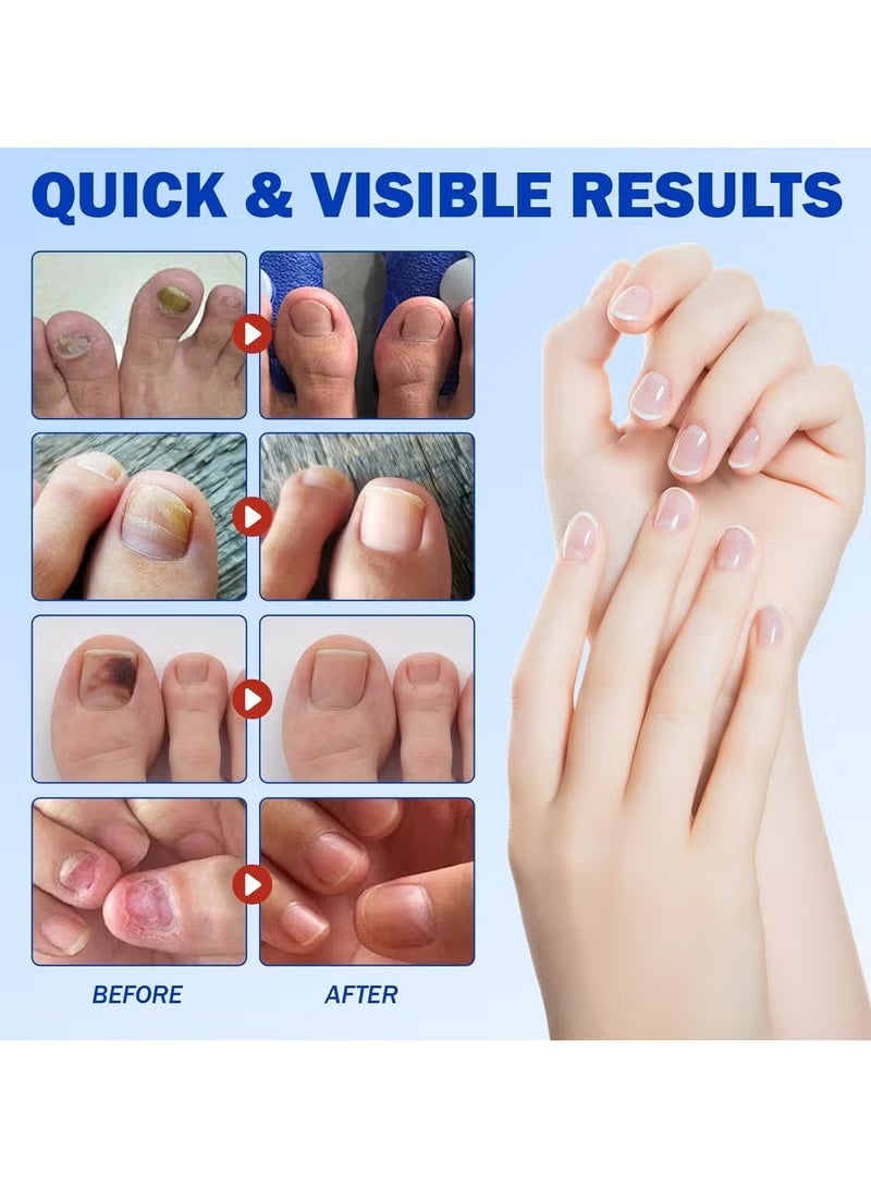 ATRJSZ Fungal Nail Patches: Overnight Repair, Nail Renewal, Quick & Visible Results. - Image 3