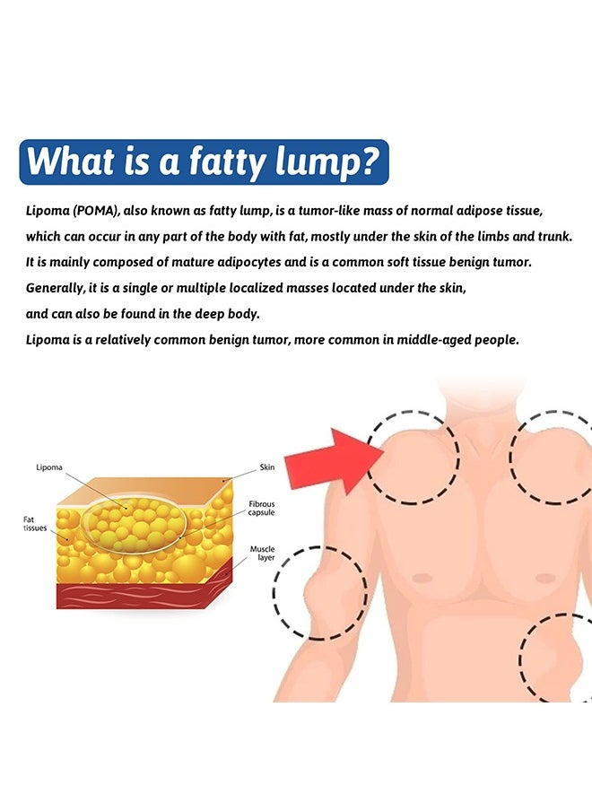 SOUTH MOON Lipoma Removal Cream 50g，Friendly Lipoma Treatment Cellulite Cream for Lipolysis Fat Lump Removal and Nodular Discomfort for Body and Face  - Image 4