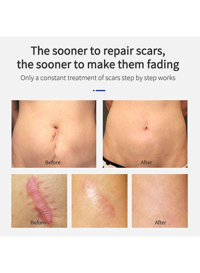 MSLAM Shark Scar Treatment Gel，Scar removal cream, scar repair cream, remove scar stretch marks, relieve and burn repair acne marks (20g) - Image 4