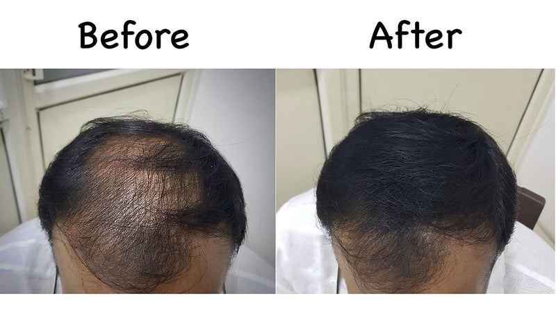 Fix-O-Fit FixOFit Hair Building Fibers Instant Hair Thickening Bald Spot Concealer Natural Finish Easy to Apply Wind Sweat Resistant Black 8g Pack of 1 - Image 5