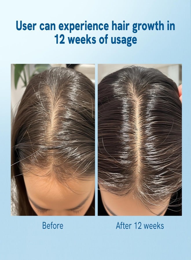 Bodywise Be Bodywise Rosemary Hair Growth Roll-On Serum (25Ml) & Derma Roller,3% Redensyl,2% Aminexil & 2% Anagain For Thicker Hair Growth,0.5Mm Titanium Micro Needles For Better Follicle Stimulation - Grams - Image 3