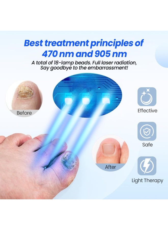 أوشيما جهاز علاج فطريات الأظافر , جهاز الليزر الفطريات الأظافر , علاج الأظافر القابلة للتعديل , تحسين الفطريات , أظافر متعددة على اليدين والقدمين آمنة وفعالة للاستخدام المنزلي - Image 3