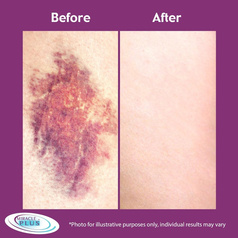 Miracle Plus Arnica Cream Bruise Relief Lotion For Bruising And Swelling On Skin | Arnica Montana Extra Strength Vitamin K Cream | Skin Care Body & Face Moisturizer With Horse Chestnut, 11.75 Fl Oz - Image 5